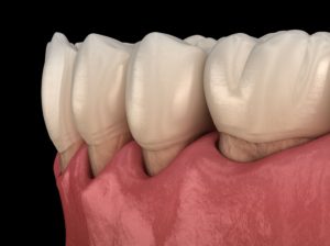 periodontal (gum) disease