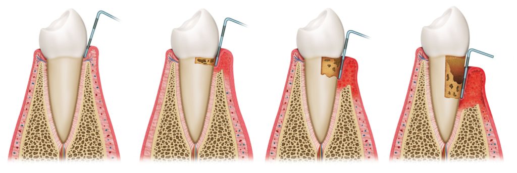 diagram of periodontal (gum) disease