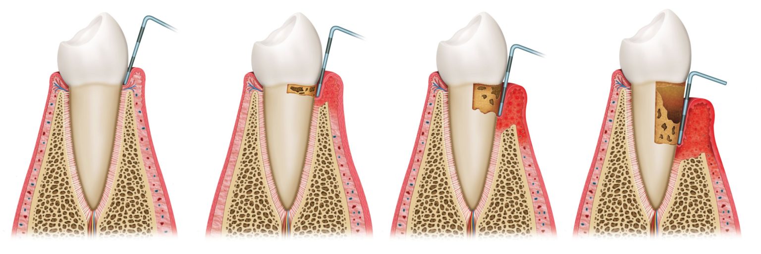 periodontal-gum-disease-kai-dental