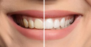 before and after photo of teeth whitening treatment